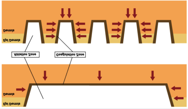 Portable Microneedle rf - Image 4