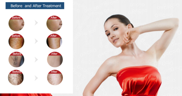 MONA ONE - IPL + E-Light+SHR SHR-950B - Image 3